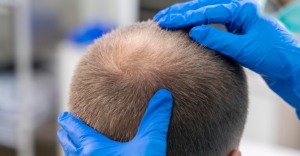Understanding the Hair Growth Cycle and its Importance in Hair Transplant